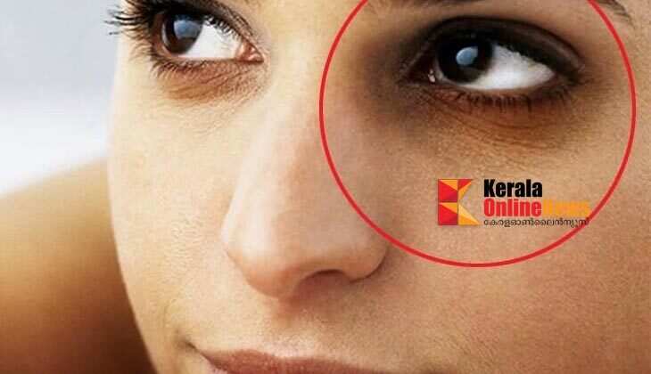 dark circles