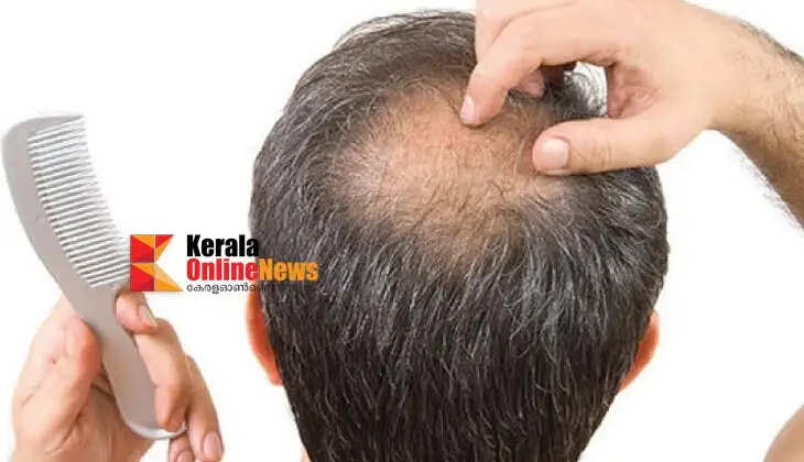 hairloss