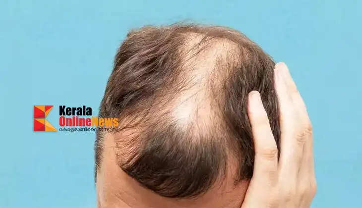 baldness