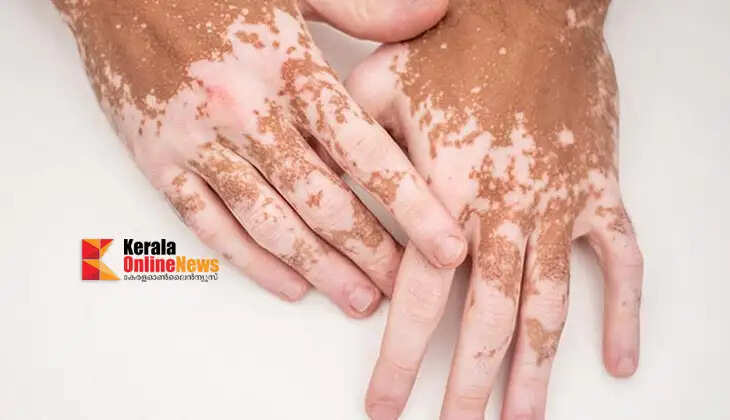 vitiligo