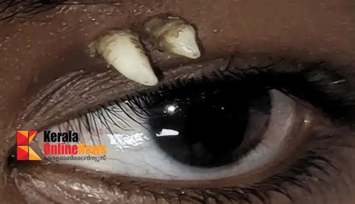 A rare disease in which teeth grow in the eye socket; What is 'ectopic tooth'?