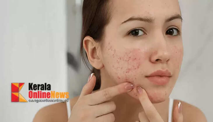 acne-prone skin