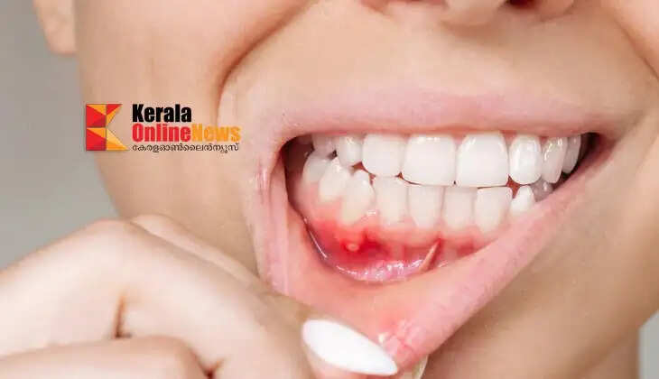 gum disease