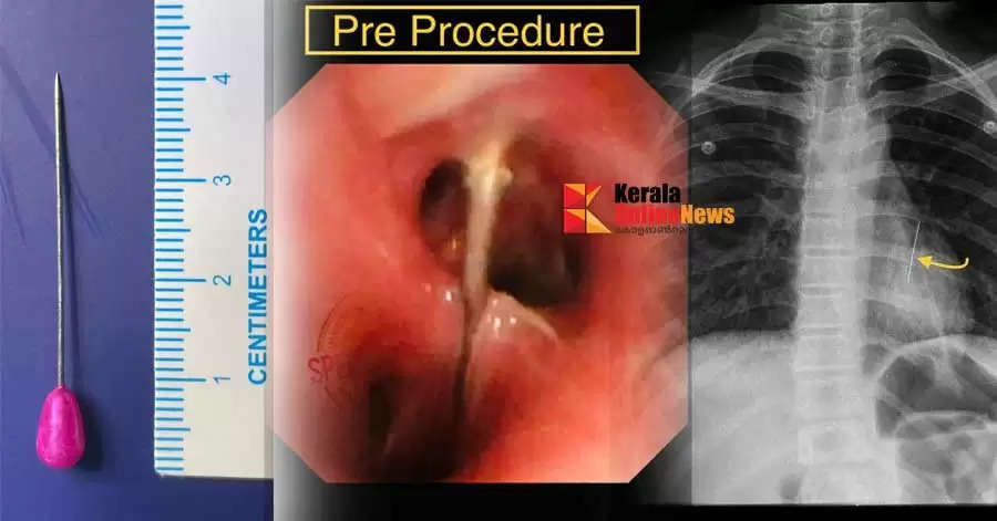 The child who swallowed the scarf was saved through surgery at Aster mims  Kannur