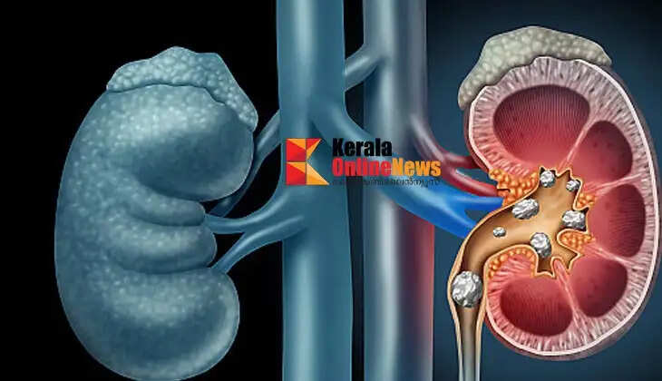 kidneystone