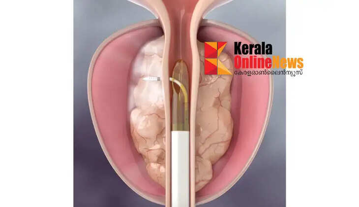 പ്രോസ്റ്റേറ്റ് വീക്കം; ചികിത്സയിൽ നിർണായക പുരോഗതി ;ദക്ഷിണേന്ത്യയിൽ ആദ്യമായി റീസം വാട്ടർ തെറാപ്പിയുമായി ആസ്റ്റർ മെഡ്&zwnj;സിറ്റി