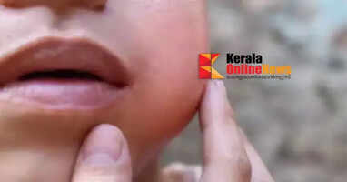 Beware of mumps: DMO