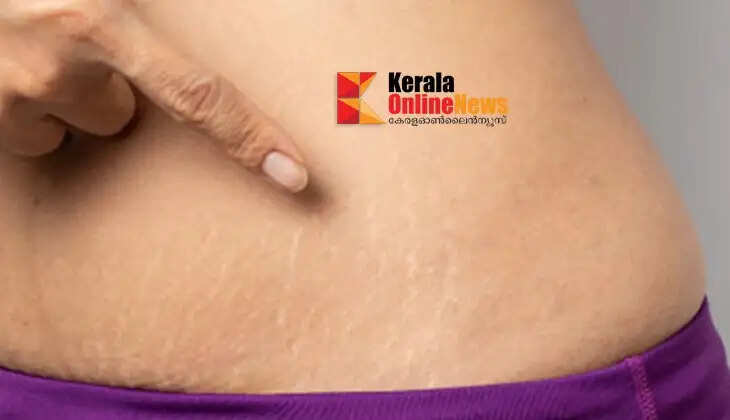 stretch marks