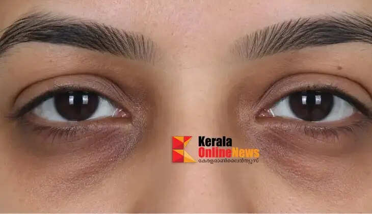 dark circles