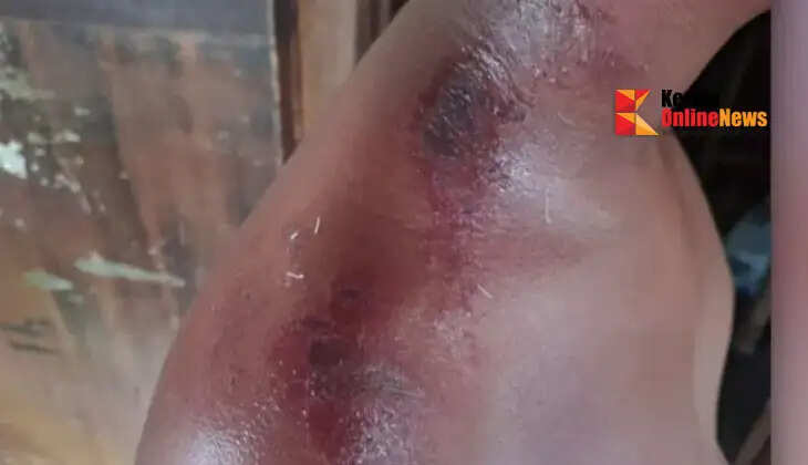 A 10-year-old boy suffered a heatstroke while playing in Kollam.