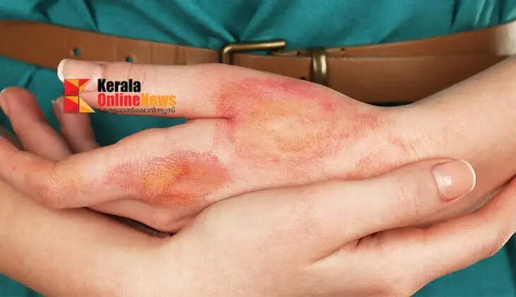 burn scars