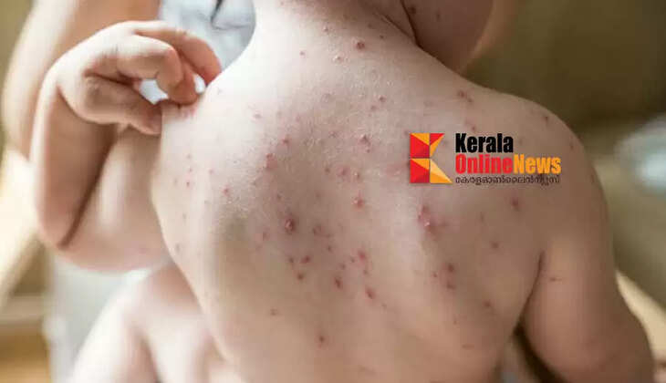 chicken pox