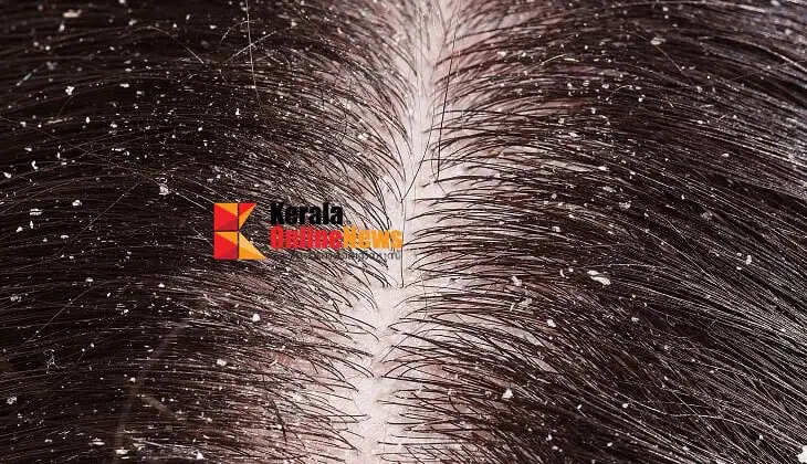 Here are some simple remedies to get rid of dandruff and prevent hair loss.