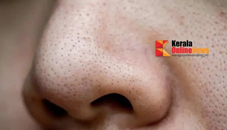 remove blackheads