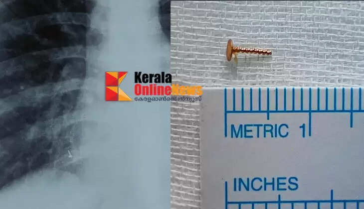 The part of the nostril that was missing years ago was removed from the lungs