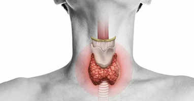 hypothyroidism