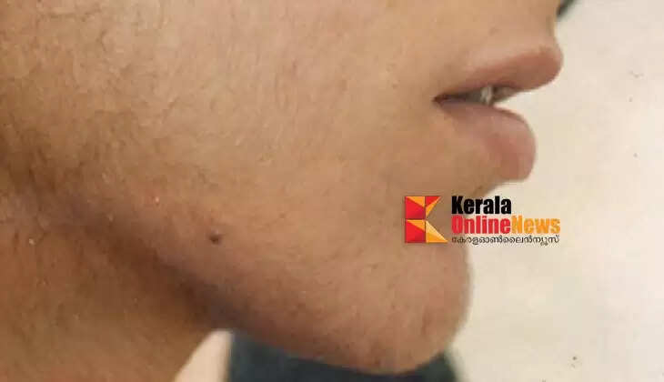 excessive hair growth