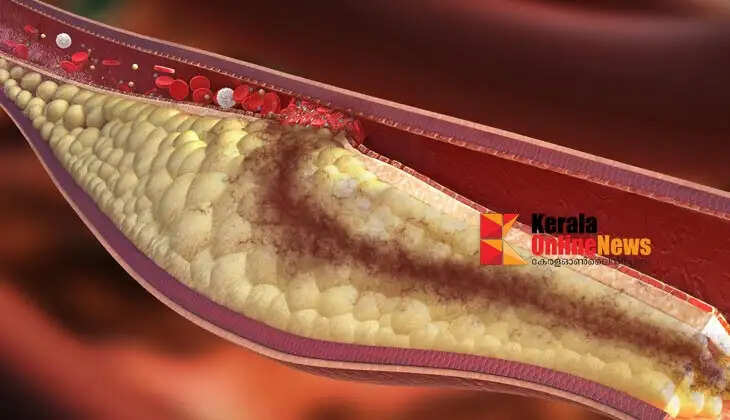 cholesterol