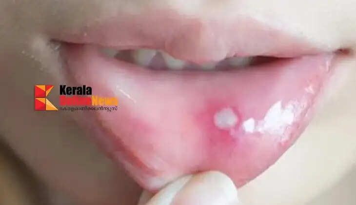 Do you have a severe mouth ulcer? There is a simple solution in the kitchen.