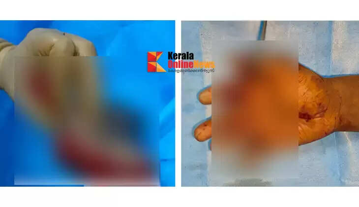 Fingers severed after getting caught in a wood-cutting machine; Jharkhand native's fingers stitched together at Kannur Aster MIMS after 15-hour surgery