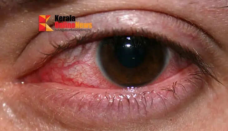 pink eye