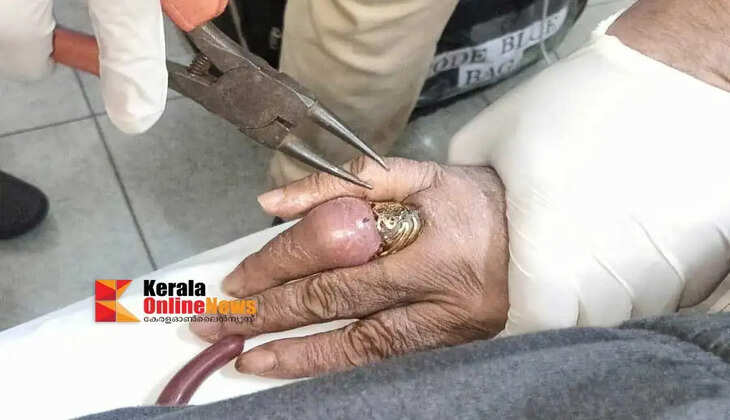 Payyannur Fire Department removes ring stuck in finger