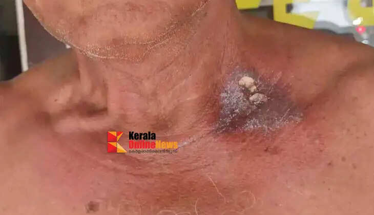 Elderly man suffers sunstroke while riding scooter in Palakkad