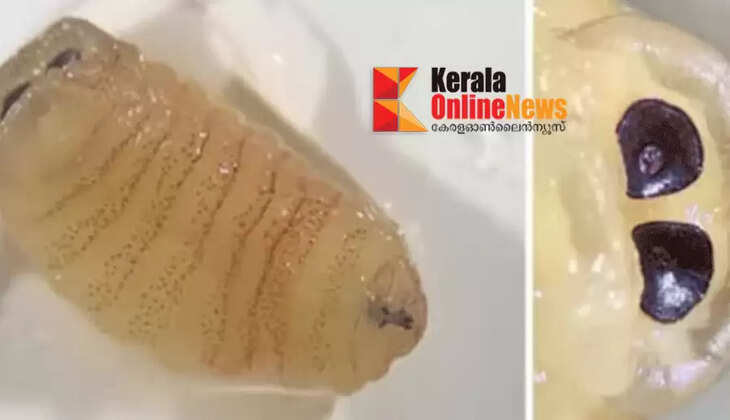 58-year-old woman suffers from rare condition that causes worms to come out of her nose when she sneezes