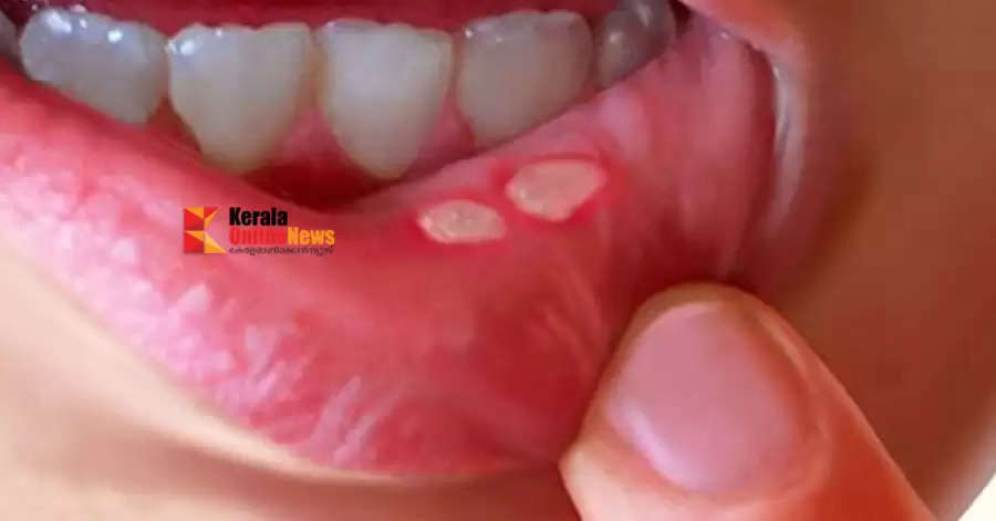  Mouth Ulcers 