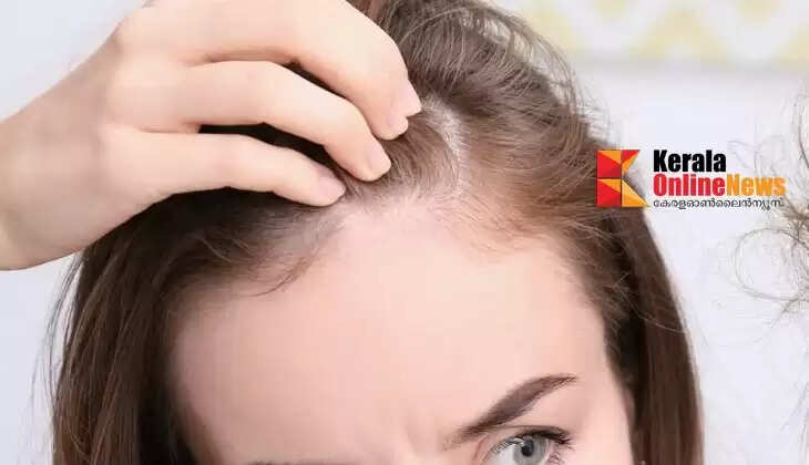 Hairloss