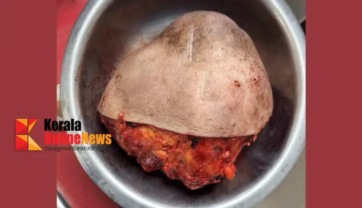 Rare surgery at Taliparamba Cooperative Hospital; 4 kg tumor removed from young woman's breast