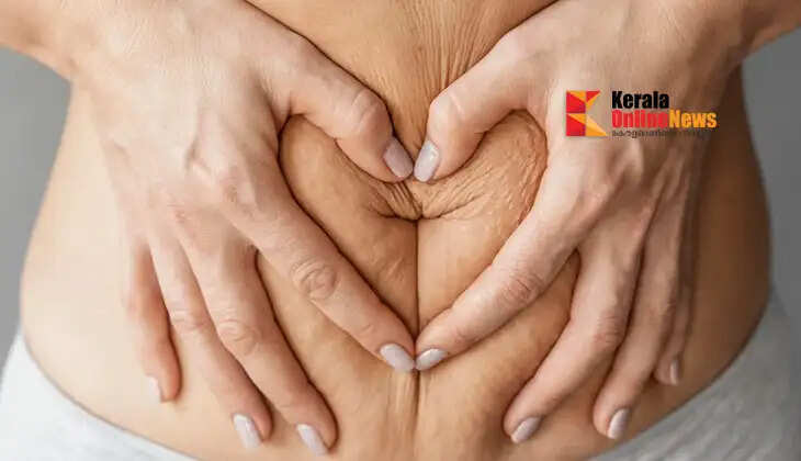 Postpartum stretch marks? Here's the solution!