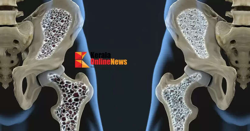 osteoporosis