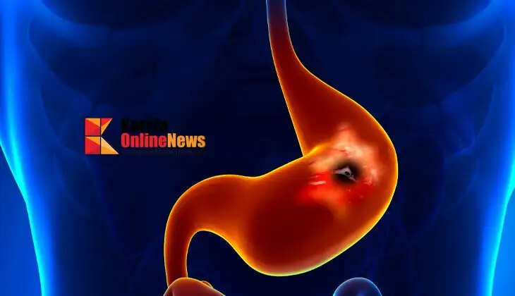 ulcers