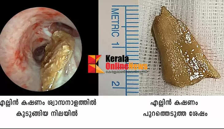 85-year-old with dyspnea and restlessness while eating dinner;  A piece of bone was removed from the lung