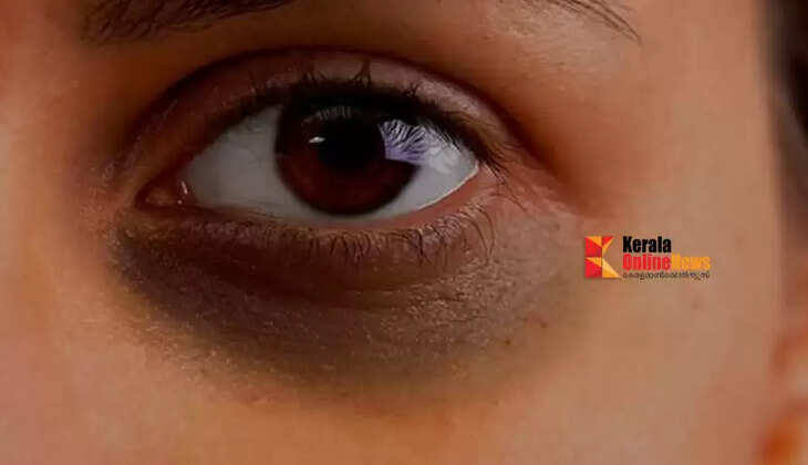 dark circles