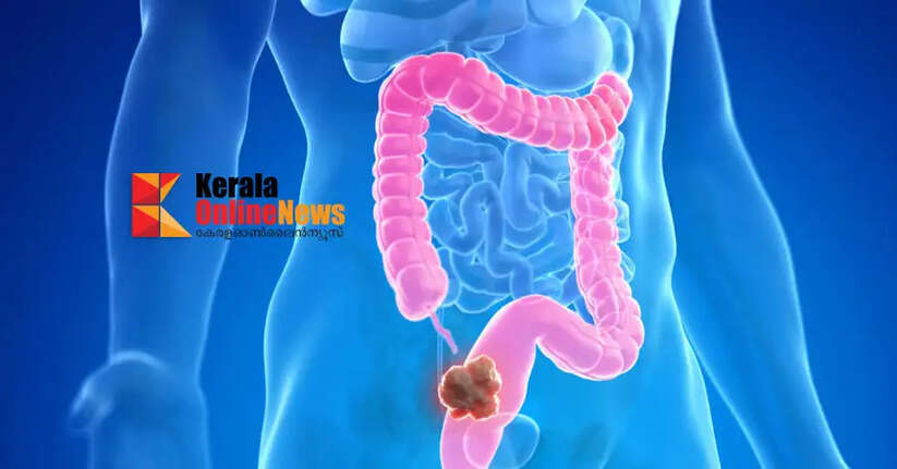 colon cancer