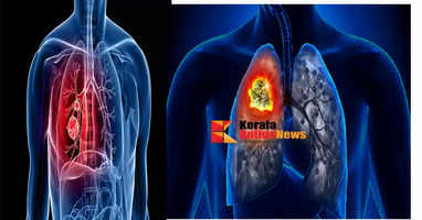 lung cancer