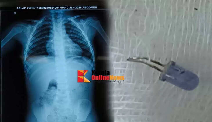 Doctors at Kannur Medical College Hospital remove bulb stuck in three year old trachea