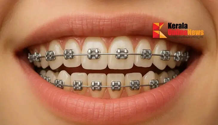 braces
