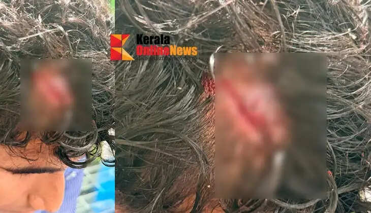 A Plus One student at PRM Higher Secondary School in Kolavallur, Kannur, suffered a severe head injury during a ragging incident; six senior students have been expelled.