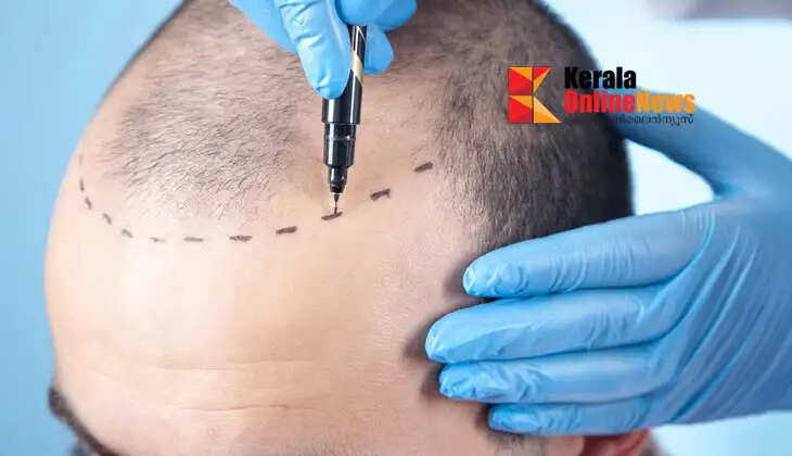 Hair transplant treatment; Tamil Nadu government tightens rules