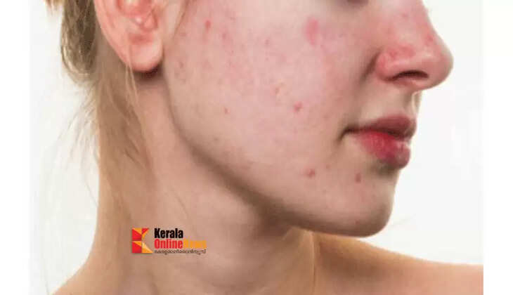 pimples