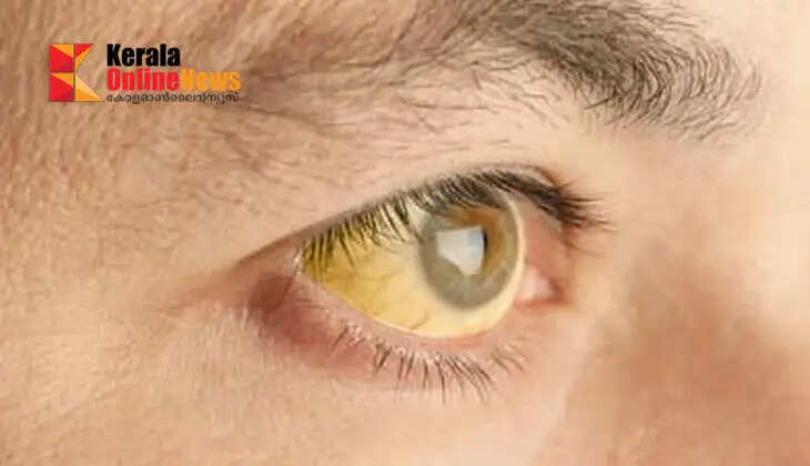 Jaundice should be avoided in summer.