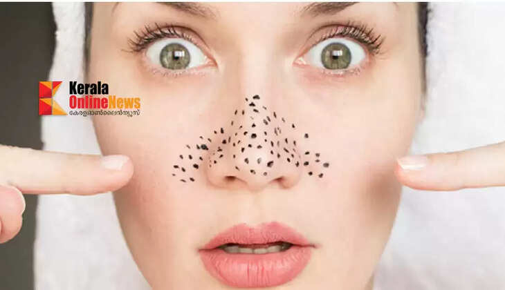 blackheads