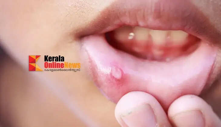 mouth ulcers