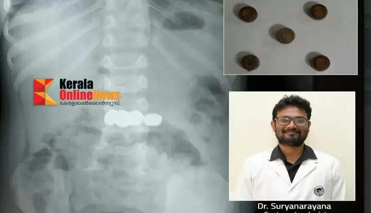 Five batteries swallowed by a two-year-old boy in Wayanad safely removed through endoscopy