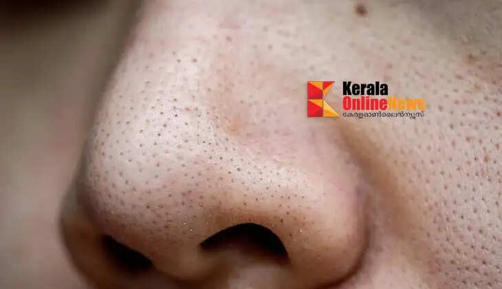 blackheads