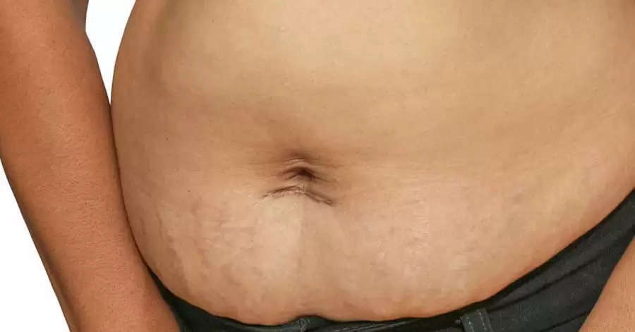 post partum belly