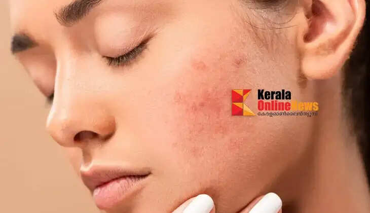 remove dark spots